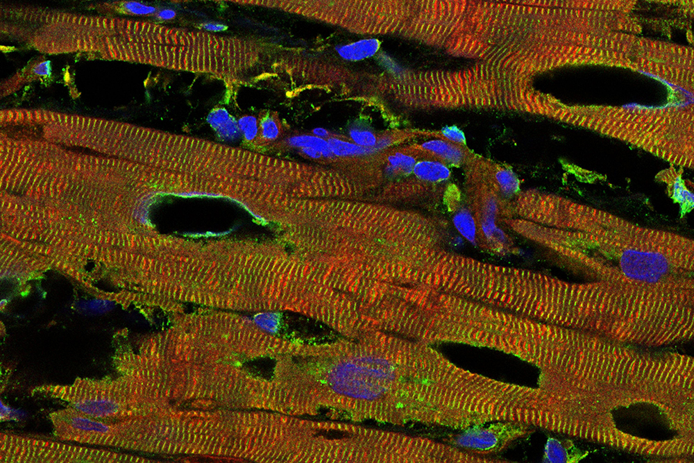Herzgewebe einer an der dilatativen Kardiomyopathie erkrankten Person. Die Rotfärbung zeigt Titin, die Grünfärbung einen anderen Marker der kontraktilen Einheiten, die Blaufärbung die Zellkerne. Löcher deuten auf die beginnende Zerstörung des Gewebes hin.