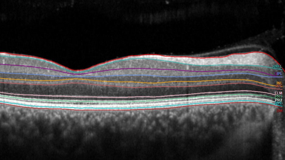 Querschnitt durch die menschliche Netzhaut mit Darstellung der verschiedenen Schichten – erfasst mittels „Spectral domain-optische Kohärenztomographie“ (SD-OCT).