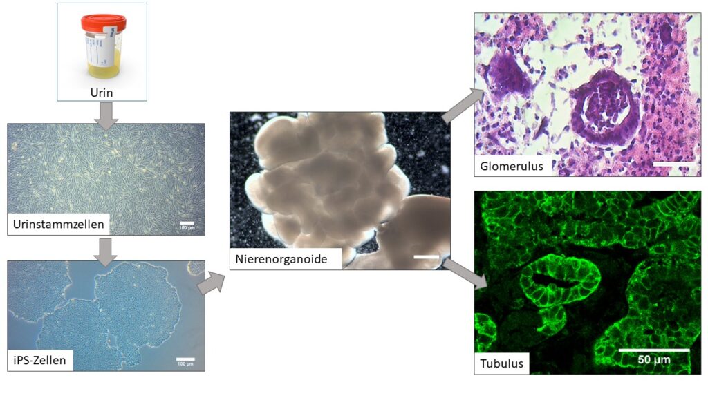 Die Abbildung zeigt die Vorgehensweise, Nierenorganoide aus Urinstammzellen-generierten induzierten pluripotenten Stammzellen (iPSCs) zu generieren. Daraus entstandene Nierenstrukturen: Glomerulus, bedeckt von spezialisierten Epithelzellen, bekannt als Podozyten, und Tubuli 