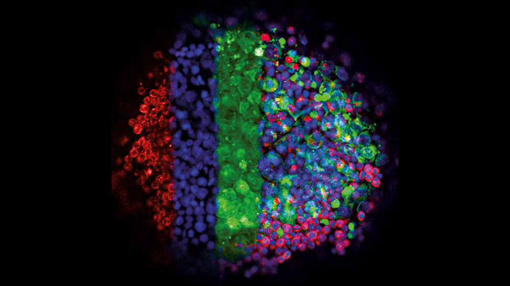 Fluoreszenzaufnahme der Interaktion von Keimzelltumor-Zellen (grün) und Endothelzellen (rot) in einem 3D-Kultursystem (Zellkerne blau). Die linke Hälfte zeigt die einzelnen Zellpopulationen, die rechte Seite deren Interaktion.