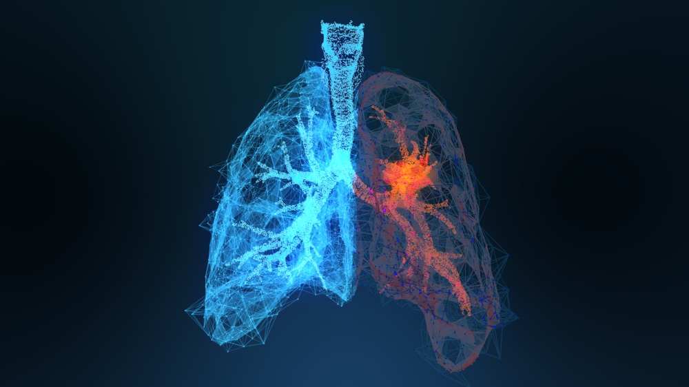 Symbolbild: Lunge mit Tumor.  © Adobe Stock