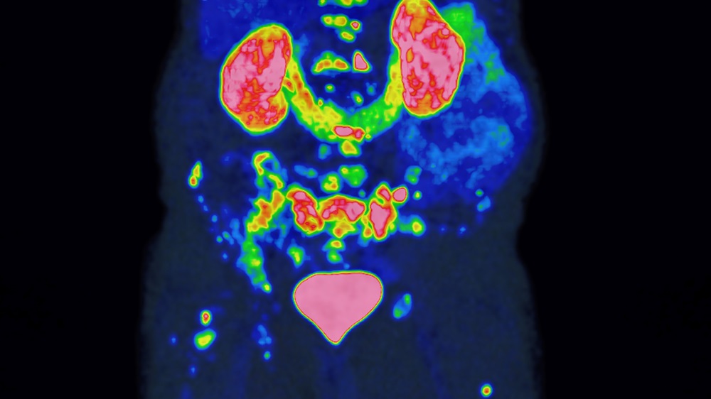 Das Bild zeigt das Ergebnis einer Prostata-spezifischen Membran-Antigen Positronen-Emissions-Tomographie. Die PSMA-PET ist ein hochmodernes Bildgebungsverfahren, mit dem sich Prostatakrebszellen besonders präzise darstellen und ihr Ausbreitungsstadium im Körper sichtbar machen lassen
